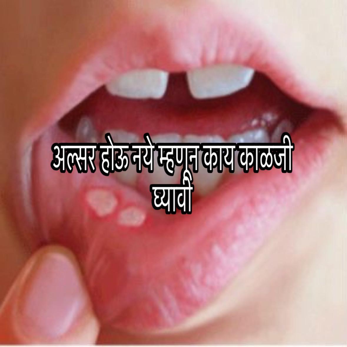 Mouth ulcer home remedies in Marathi 