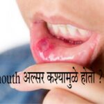 Mouth ulcer home remedies in Marathi