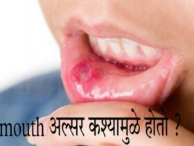 Mouth ulcer home remedies in Marathi