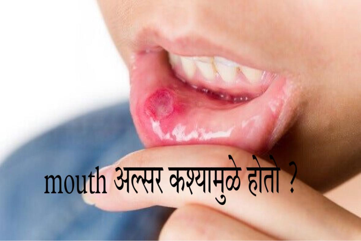 Mouth ulcer home remedies in Marathi