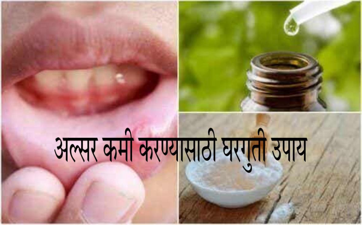 Mouth ulcer home remedies in Marathi 